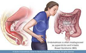 To take action the ovarian cancer symptom that's seen as 'normal'. Bowel Endometriosis Symptoms Why Does Endo Masquerade As Ibs
