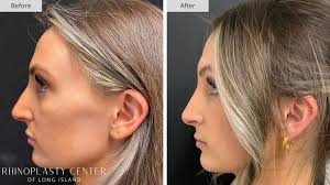 Expert Revision Rhinoplasty in Long Island, New York
