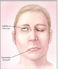 Distinguishing bell's palsy vs stroke can be done with the following steps: A Patient With Bell S Palsy Who Has Been Asked To Close His Eyes Download Scientific Diagram
