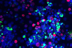 Inform yourself about the role viruses play in contributing to cancer. Protein Found In Aggressive Ovarian Cancers Promotes Tumor Growth By Bringing In Protective Immune Cells Newsroom Weill Cornell Medicine
