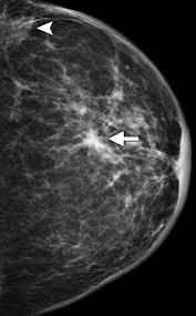 Breast cancer is a disease in which certain cells in the breast become abnormal and multiply uncontrollably to form a tumor. What Radiologists Need To Know About Diagnosis And Treatment Of Inflammatory Breast Cancer A Multidisciplinary Approach Radiographics