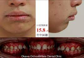 May 27, 2021 · 敵「出っ歯ひどいから矯正だけしても多分そこまで良くならんけどやるか？ 117: 339 ã²ã©ã„å‡ºã£æ­¯ã‚'éžæŠœæ­¯ã§ å¤§å·çŸ¯æ­£æ­¯ç§'ã‚¯ãƒªãƒ‹ãƒƒã‚¯ é™å²¡çœŒæ²¼æ´¥å¸‚ã®çŸ¯æ­£æ­¯ç§' ãƒ›ãƒ¯ã‚¤ãƒˆãƒ‹ãƒ³ã‚°