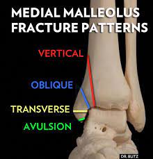 Best Certificate Programs Nursingschoolsinnc Broken Ankle Ankle Fracture Broken Ankle Recovery