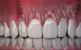 Aside from gum disease, causes of gum overgrowth include genetics and a condition called gingival fibromatosis in which healthy gum tissue grows so excessively it can. Do Gums Grow Back With Home Remedies By Stella Halligan Medium
