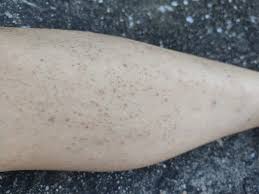 Image result for Keratosis pilaris