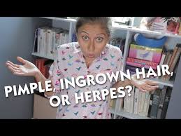 If you routinely remove body hair, chances are you've had your fair share of ingrown hairs and razor bumps. Nerdfighteria Wiki Pimple Ingrown Hair Or Herpes
