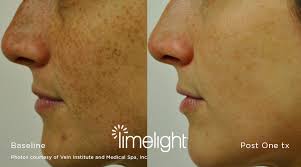 The name inhealth comes from . Laser Treatments Bangor Me Penobscot Medical Aesthetics
