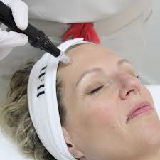 Acne Skin Treatments at Fixation Skincare in Sheffield