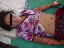Your comments on videos will be key as we. Purpuric Rash Of Meningococcemia At Presentation Reprinted With Download Scientific Diagram