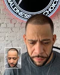 Expert Scalp Micropigmentation in NYC