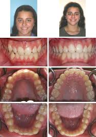 Check spelling or type a new query. Invisalign Braces In Ebensburg Pa Joseph Cavalier Dmd