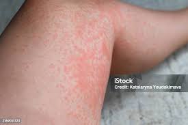 Image result for Photodermatitis