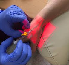 Image result for Difficult Intravenous Access in Children