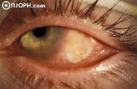 Image result for TULAREMIA