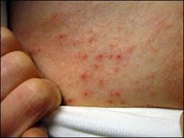 How Can Dermatitis Herpetiformis Be Treated? - Dr. Vikram's Blog - Ayurvedic and Herbal Remedies
