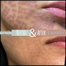 Image result for Postinflammatory Hypopigmentation