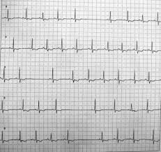 Check spelling or type a new query. Gambaran Ekg Aritmia Alomedika