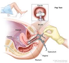 In its early stages, cervical cancer typically does not cause symptoms. Cervical Cancer Screening Pdq Patient Version National Cancer Institute