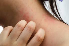 Image result for contact dermatitis