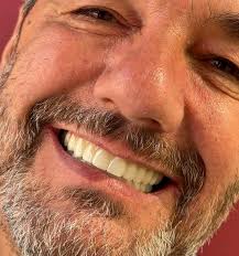 Un sorriso nuovo, naturale e stabile. Stefano ha scelto @dent.italia … e il  risultato parla da solo. ✨ Një buzëqeshje e re, natyrale dhe e qëndrueshme.  Stefano zgjodhi @dent.italia … dhe rezultati