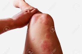 Image result for allergy rash on the legs