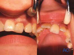 Image result for Tooth Luxation