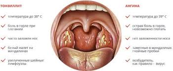 Chem Otlichaetsya Angina Ot Tonzillita