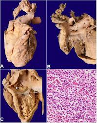 Scielo Brasil Alk Anaplastic Large Cell Lymphoma With Extensive Cardiac Involvement A Rare Case Report And Review Of The Literature Alk Anaplastic Large Cell Lymphoma With Extensive Cardiac Involvement A