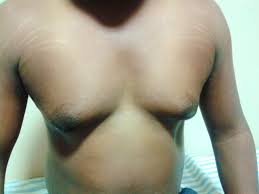 Most of the lesions are idiopathic, but enlargement due to various physiological and pathological causes may occur. Male Breast Cancer Random Reflections Of A Breast Cancer Surgeon