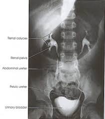 Image result for Intravenous Pyelogram