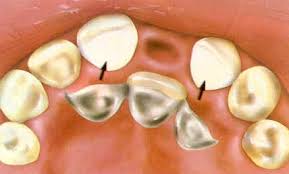 Resin Bonded Bridges Everything Dentistry