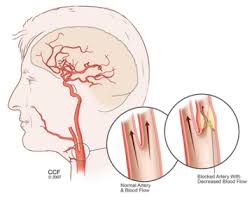 Just like arteries in the heart and elsewhere in the body, the carotid arteries can become clogged with fatty deposits. Carotid Artery Disease Carotid Artery Stenosis Treatments
