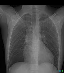 Marfan Syndrome Aortic Root Dilatation Radiology Case Radiopaedia Org Radiology Marfan Syndrome Radiology Nursing