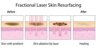 Check spelling or type a new query. Icon 1540 Non Ablative Fractionation Laser Fraxel Newport Aesthetics By Dr Ann Mai Md 949 660 9972