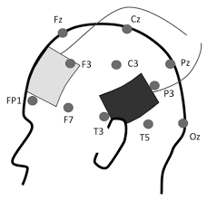 Electrode Montage Of The Fronto Temporal Tdcs Protocol Used