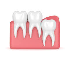 Check spelling or type a new query. 7 Ways To Simplify Your Recovery After Wisdom Teeth Removal Greeley Dental Health