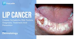Image result for Lip Cancer