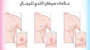 هل هناك ينفر قوة صور سرطان الثدي عند الرجال consultoriaorigenydestino com