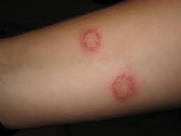 It appears as red and bumpy areas which may occur anywhere on the body, but favours the elbows and knees as well as the back of the hands and feet. Common Skin Rashes And What To Do About Them