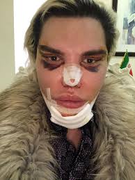 The cat eye procedure was carried out under local anaesthetic and rodrigo did not feel any pain. The Human Ken Doll Undergoes Controversial Eyelid Reshaping To Look Like A Sexy Cat Irish Mirror Online