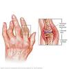 Comparison of sulfasalazine and placebo in the treatment of reactive arthritis (reiter's syndrome). Https Encrypted Tbn0 Gstatic Com Images Q Tbn And9gcqyitbfvwttnvcqvsk Lzb Zlkfc1vkdc4lvfj2eb0tapor5lka Usqp Cau