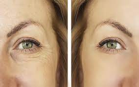 plexr goz kapagi estetigi goz kapagi estetigi plexr soft surgery 2018