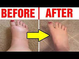 Best Home Remedies For Swollen Feet How To Reduce Swollen Feet Youtube Swelling Feet Remedies Swelling Remedies Swollen Feet