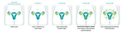 Suspected or confirmed ovarian cancer is staged surgically (see table figo surgical staging of ovarian, fallopian tube, and peritoneal cancer). Ovarian Cancer Physiopedia