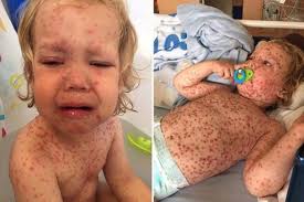Tot was hospitalised for five days after getting the worst chicken pox  doctors had ever seen