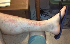 Maybe you would like to learn more about one of these? Hiker S Rash Red Rash Between Knee And Ankle After Hiking For Several Hours