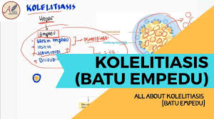 Pada kesempatan kali ini kami akan berbagi artikel tentang laporan pendahuluan / lp cholelithiasis / kolelitiasis ( batu empedu). Patogenesis Kolelitiasis Batu Empedu Youtube