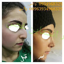 تجميل الأنف _سوريا...