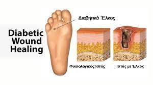 Diabetic Wound Healing Youtube