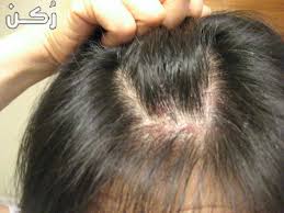 علاج فطريات الشعر بالطب البديل أسباب فطريات الشعر موقع ر كن